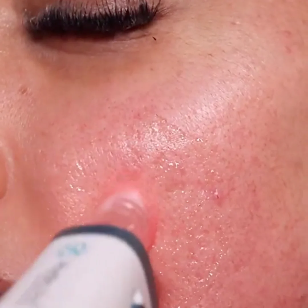 *NEW* Hydra Pen H6 Advanced Serum Infusion Microneedling Pen with Light Therapy - Image 5