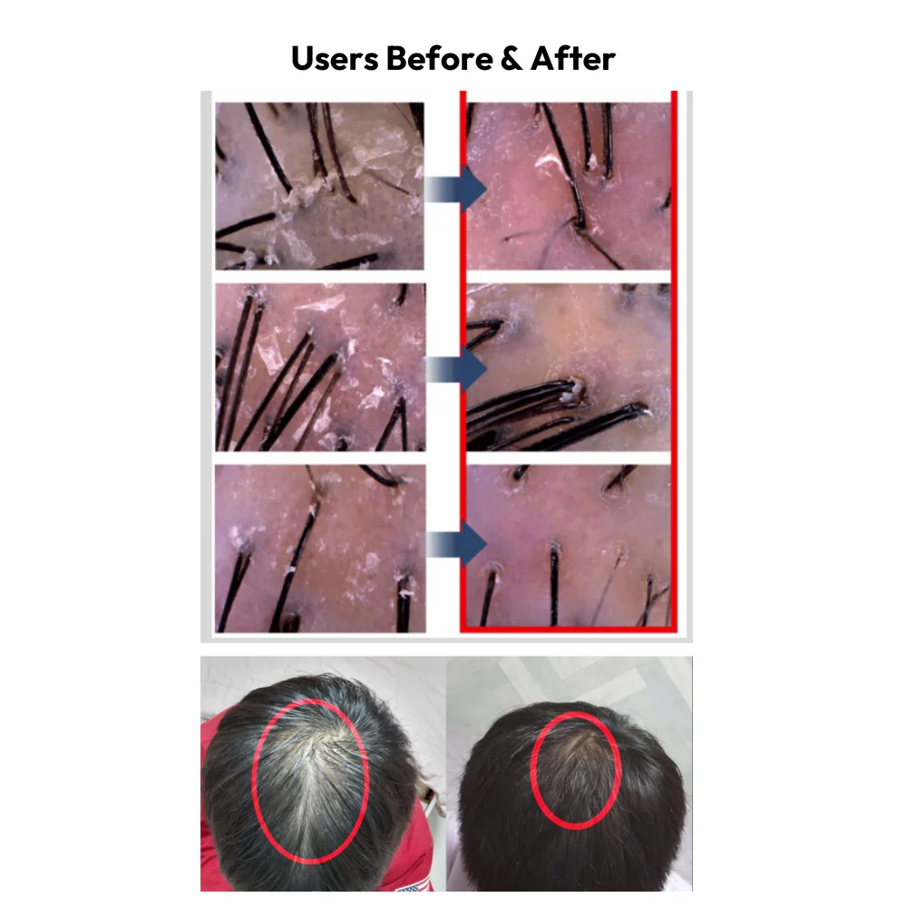 Rootonix Hair Growth Booster Scalp Care Device - Image 8